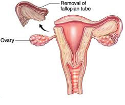 Removal of fallopian tubes can prevent ovarian cancer
