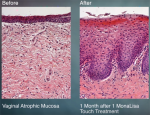 Before and after image of monalisa touch treatment for vulvar and vaginal atrophy